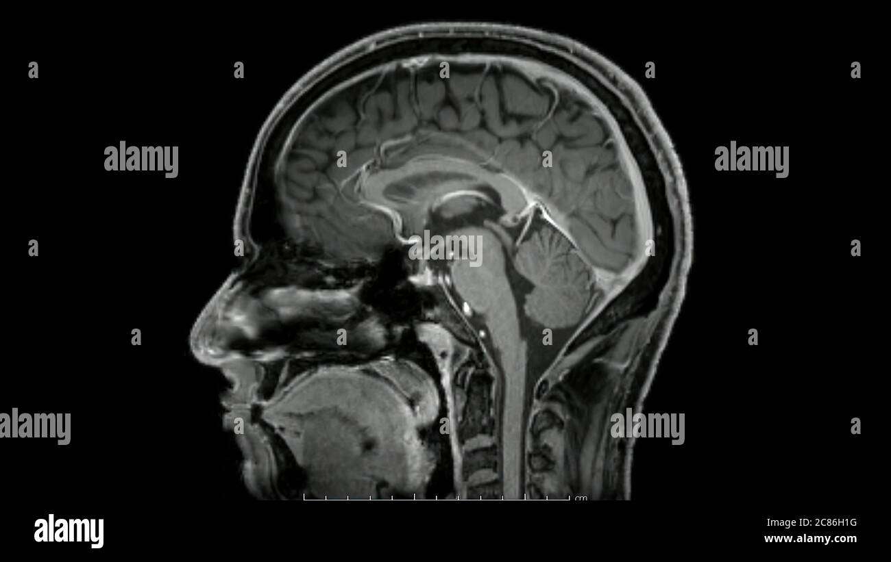 Magnetic resonance images of the brain (MRI brain) sagittal post ...