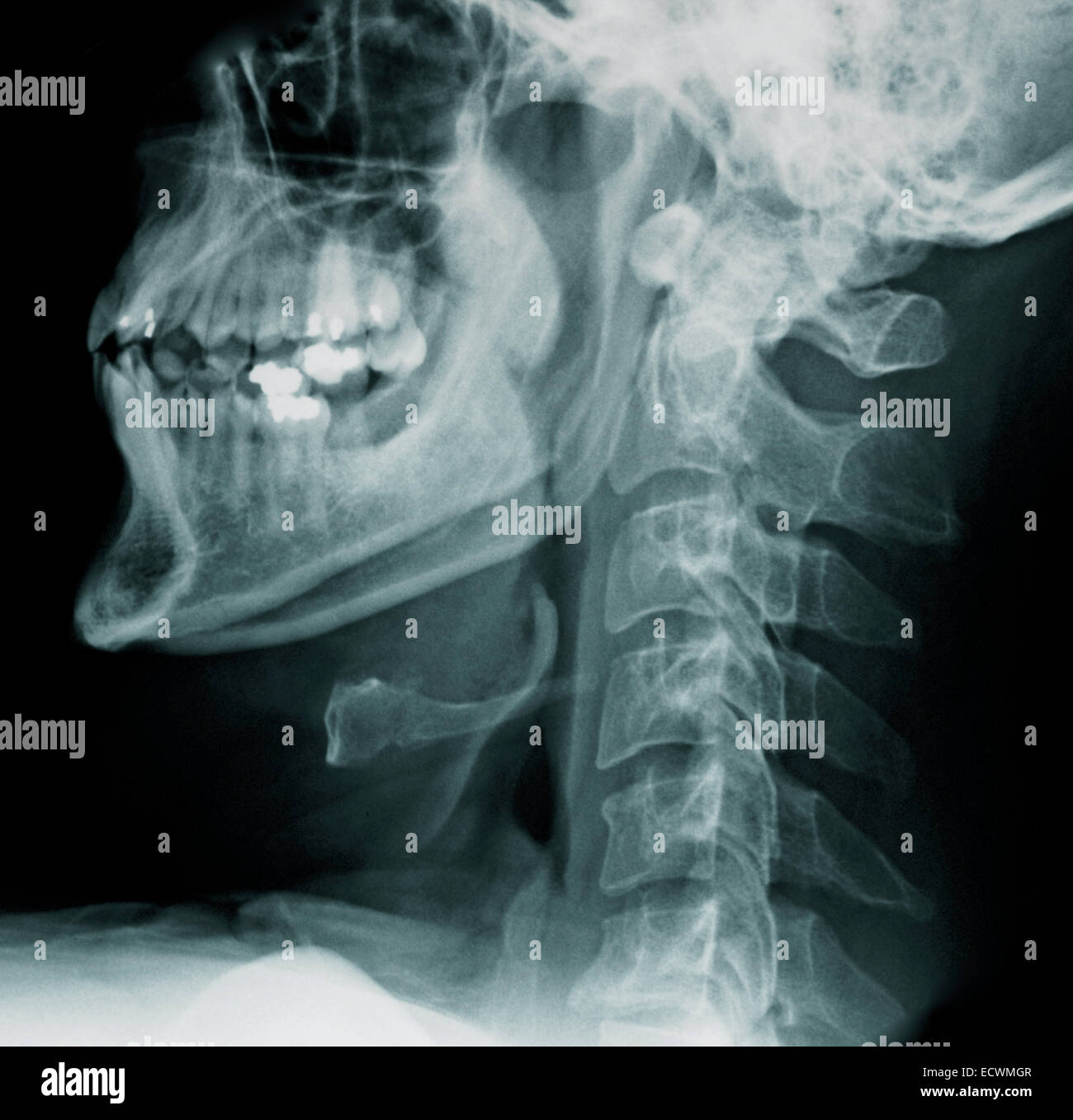x ray cervical spine normal